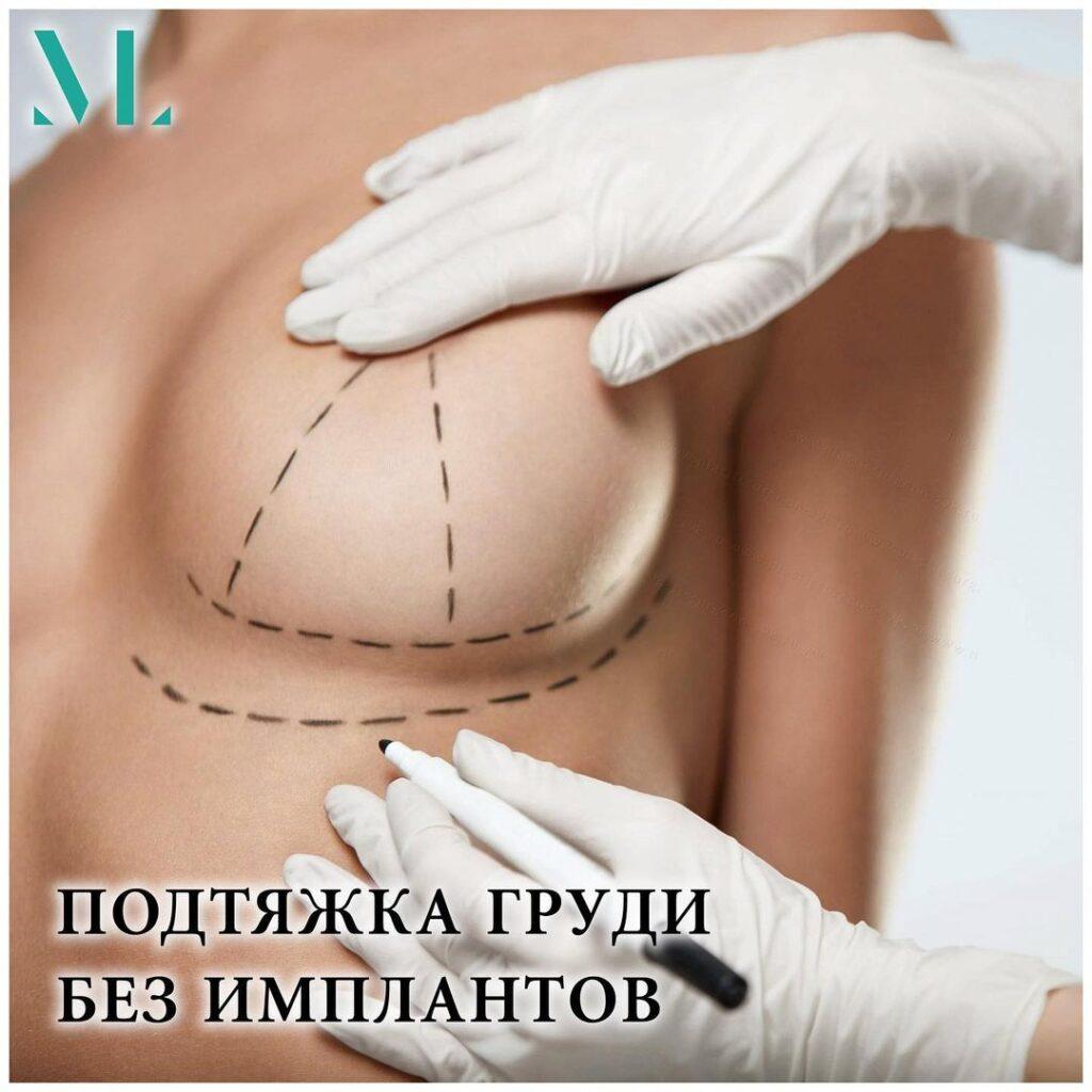 Подтяжка груди без имплантов