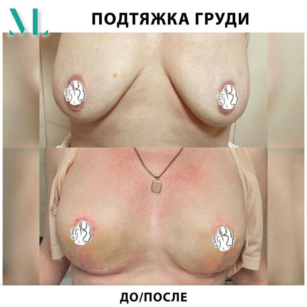 Якорная (Т-образная) подтяжка груди