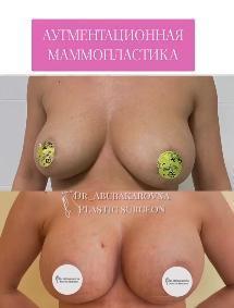 Аугментационная маммопластика